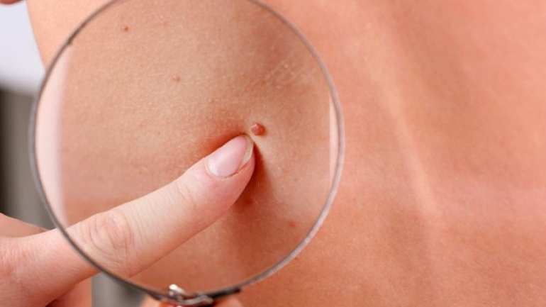 Περισσότερες από 11 ελιές στο μπράτσο δείχνουν αυξημένο κίνδυνο καρκίνου Περισσότερες από 11 ελιές στο μπράτσο δείχνουν αυξημένο κίνδυνο καρκίνου